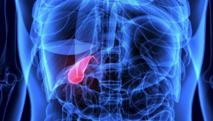 Gallstones