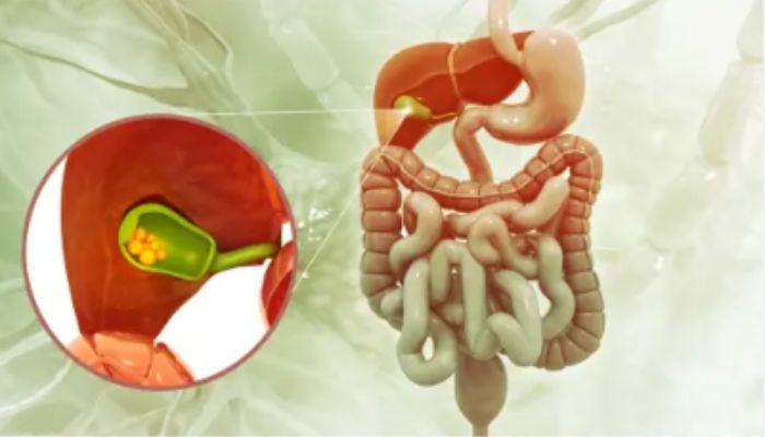 Gallstones