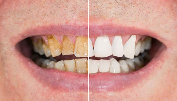 Teeth whitening with baking soda